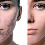 tratamiento-post-acne-y-anti-seborreico-pieles-grasas